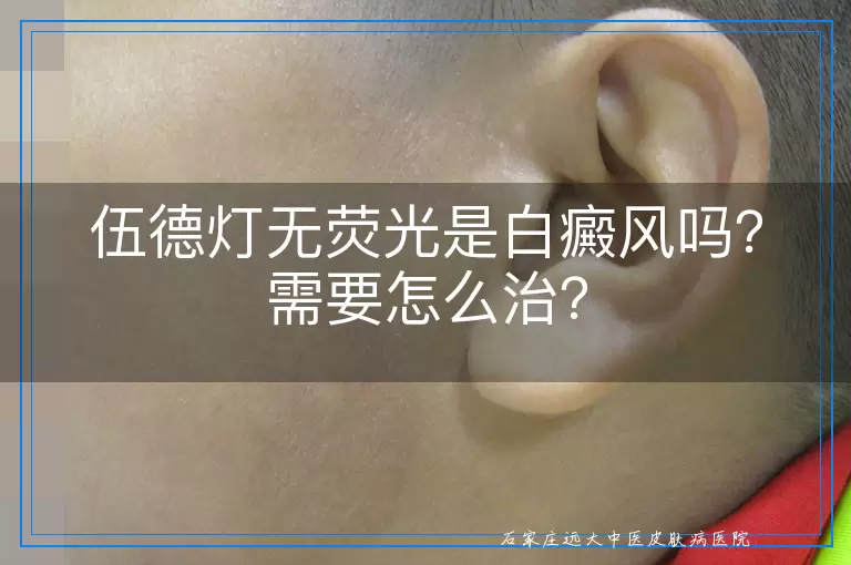 伍德灯无荧光是白癜风吗？需要怎么治？