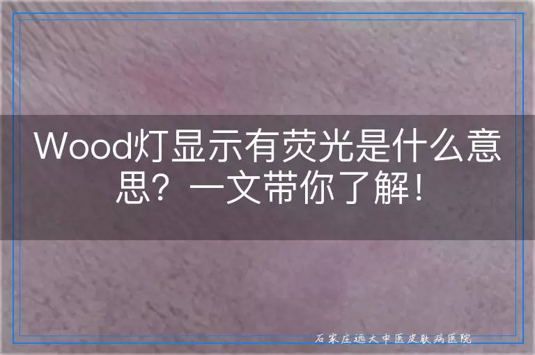 Wood灯显示有荧光是什么意思？一文带你了解！