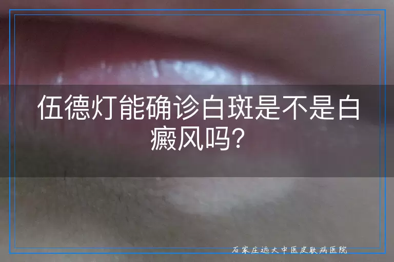 伍德灯能确诊白斑是不是白癜风吗？