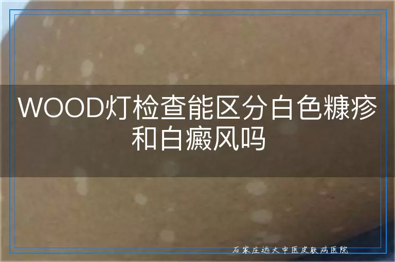 WOOD灯检查能区分白色糠疹和白癜风吗