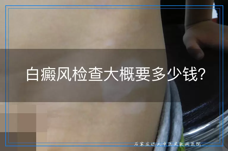 白癜风检查大概要多少钱？