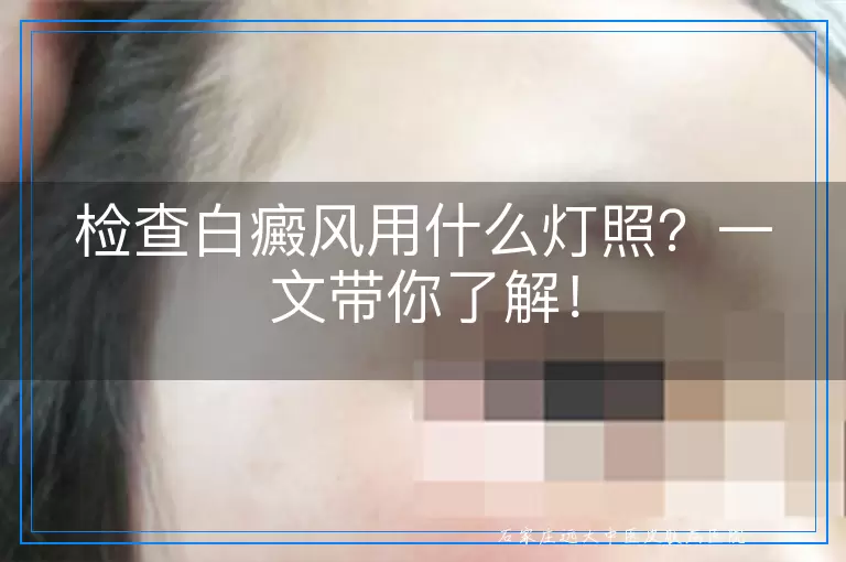 检查白癜风用什么灯照？一文带你了解！
