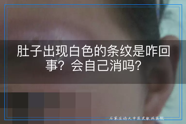 肚子出现白色的条纹是咋回事？会自己消吗？
