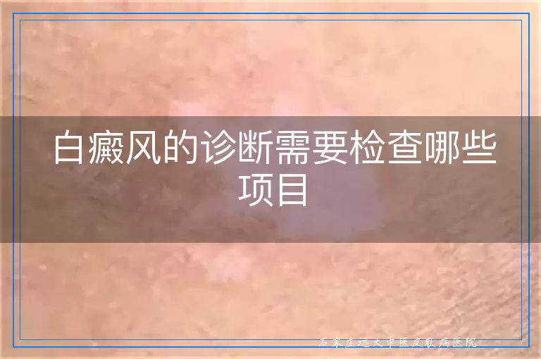 白癜风的诊断需要检查哪些项目