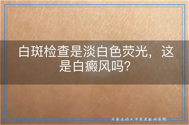 白斑检查是淡白色荧光，这是白癜风吗？