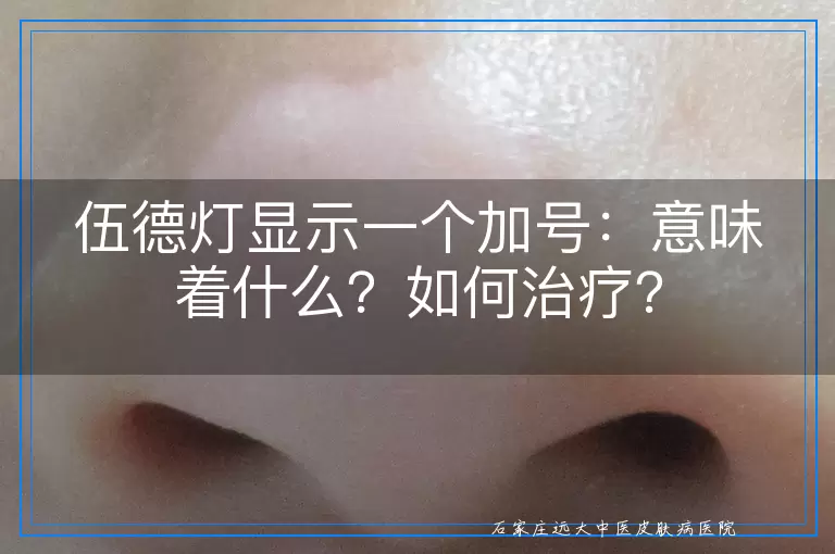 伍德灯显示一个加号：意味着什么？如何治疗？
