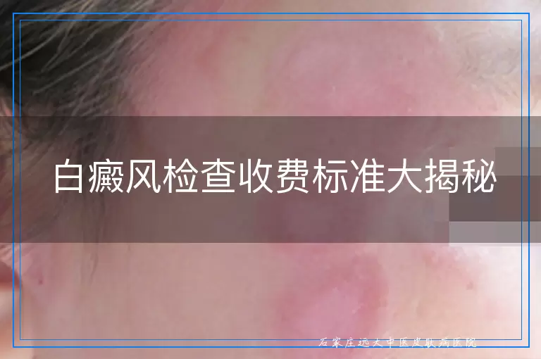 白癜风检查收费标准大揭秘