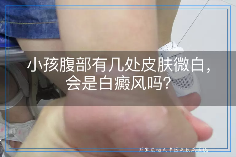小孩腹部有几处皮肤微白，会是白癜风吗？