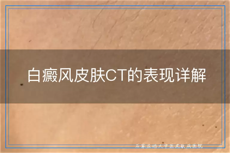白癜风皮肤CT的表现详解