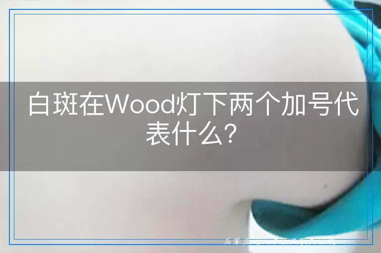 白斑在Wood灯下两个加号代表什么？