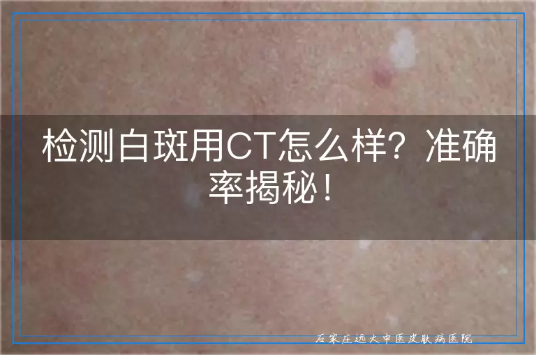 检测白斑用CT怎么样？准确率揭秘！