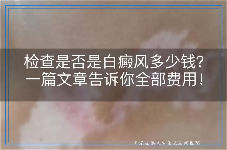 检查是否是白癜风多少钱？一篇文章告诉你全部费用！