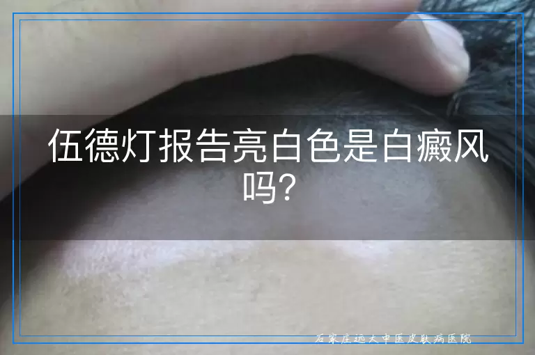 伍德灯报告亮白色是白癜风吗？