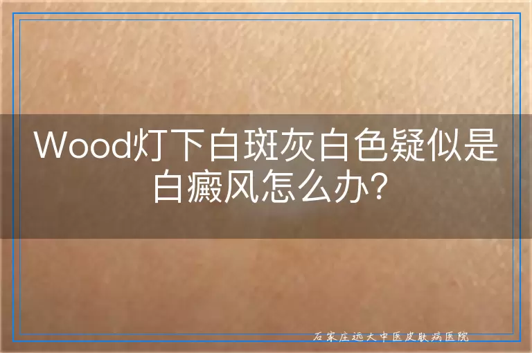 Wood灯下白斑灰白色疑似是白癜风怎么办？