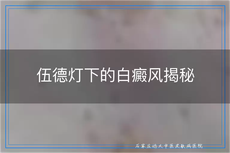 伍德灯下的白癜风揭秘