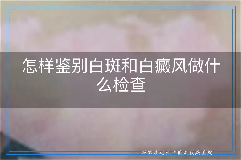 怎样鉴别白斑和白癜风做什么检查