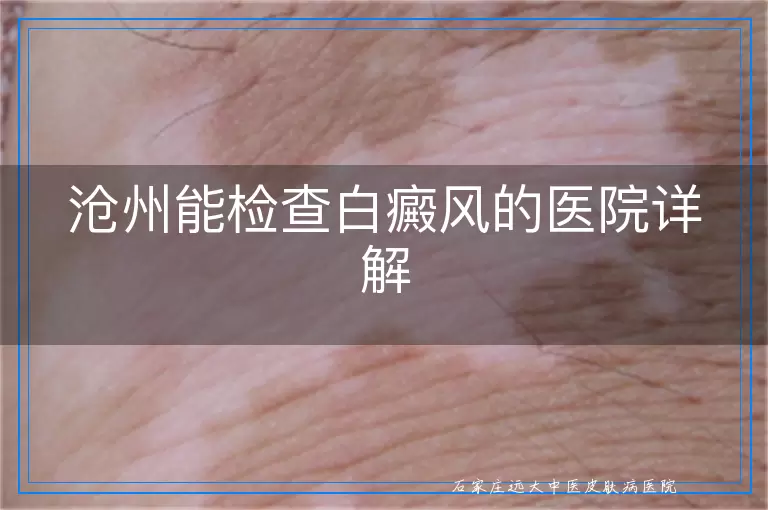 沧州能检查白癜风的医院详解