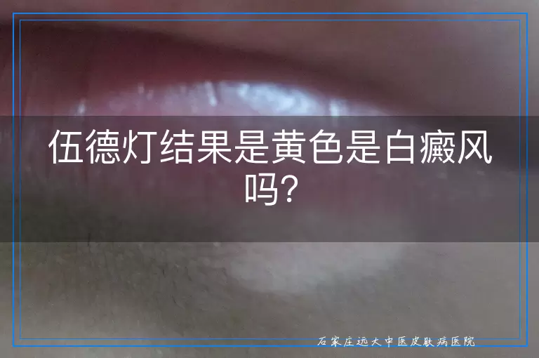 伍德灯结果是黄色是白癜风吗？