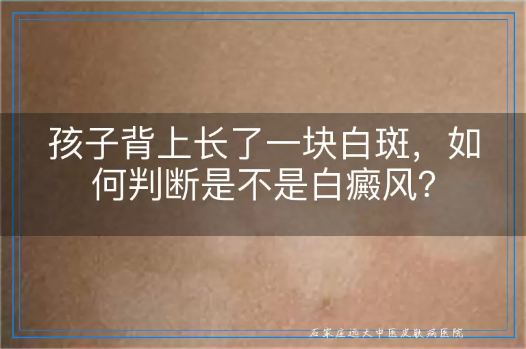 孩子背上长了一块白斑，如何判断是不是白癜风？