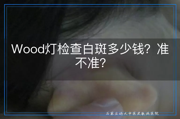 Wood灯检查白斑多少钱？准不准？
