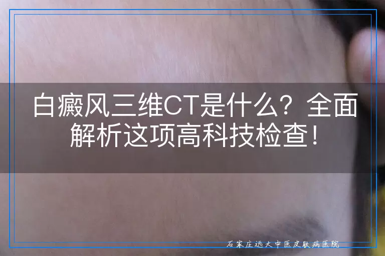白癜风三维CT是什么？全面解析这项高科技检查！