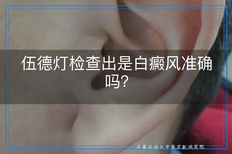伍德灯检查出是白癜风准确吗？