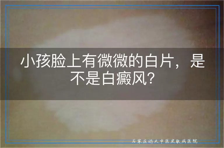 小孩脸上有微微的白片，是不是白癜风？