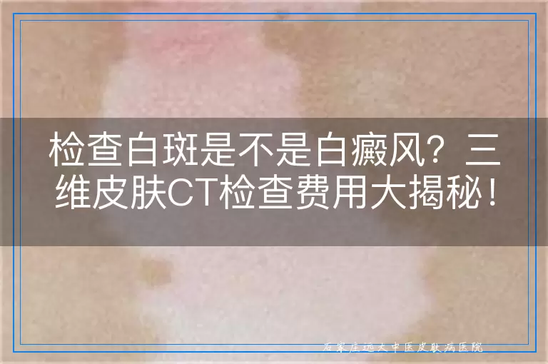 检查白斑是不是白癜风？三维皮肤CT检查费用大揭秘！