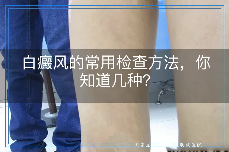 白癜风的常用检查方法，你知道几种？