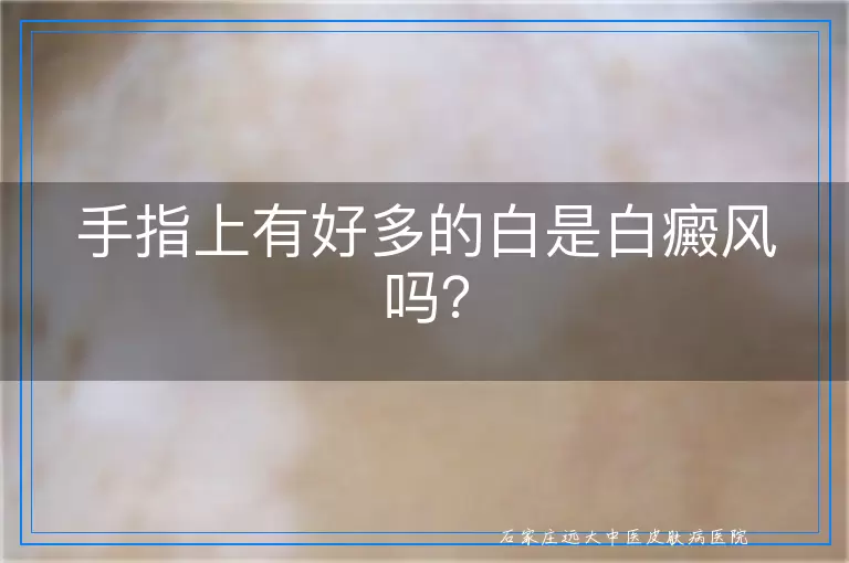 手指上有好多的白是白癜风吗？
