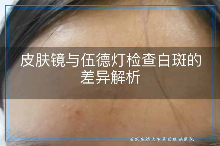皮肤镜与伍德灯检查白斑的差异解析