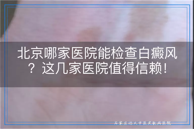 北京哪家医院能检查白癜风？这几家医院值得信赖！
