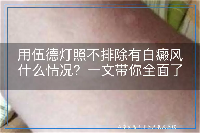 用伍德灯照不排除有白癜风什么情况？一文带你全面了解