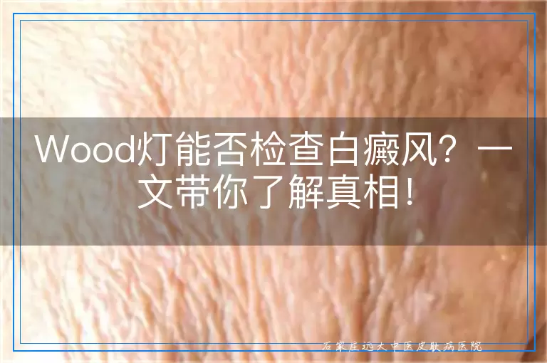 Wood灯能否检查白癜风？一文带你了解真相！
