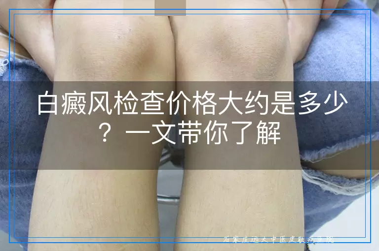 白癜风检查价格大约是多少？一文带你了解