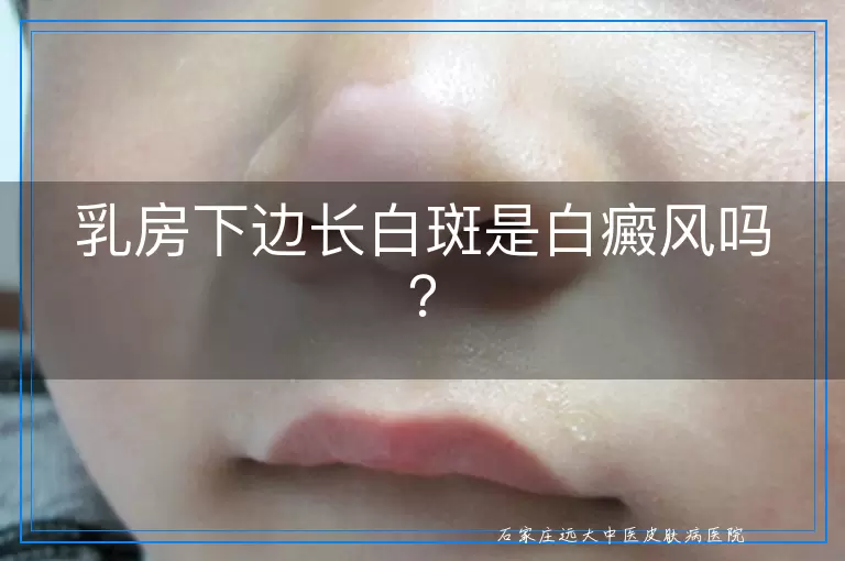乳房下边长白斑是白癜风吗？