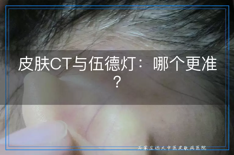 皮肤CT与伍德灯：哪个更准？