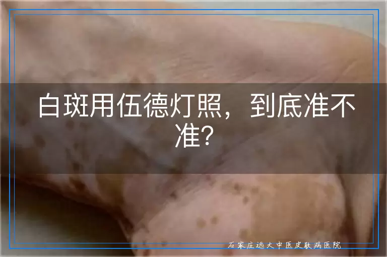 白斑用伍德灯照，到底准不准？
