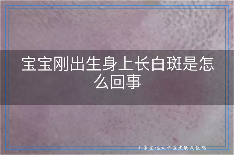 宝宝刚出生身上长白斑是怎么回事