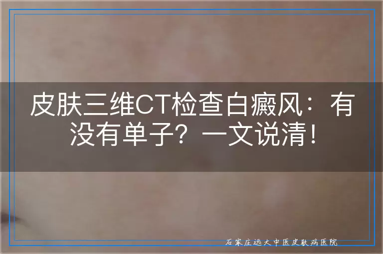 皮肤三维CT检查白癜风：有没有单子？一文说清！