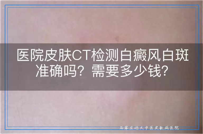 医院皮肤CT检测白癜风白斑准确吗？需要多少钱？