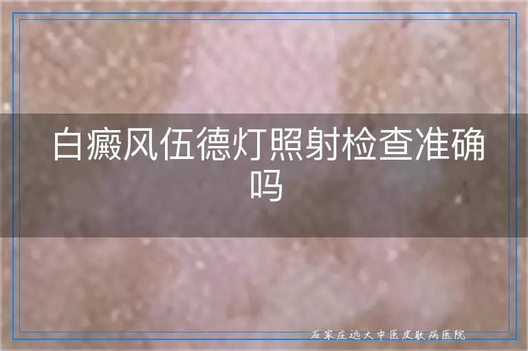 白癜风伍德灯照射检查准确吗
