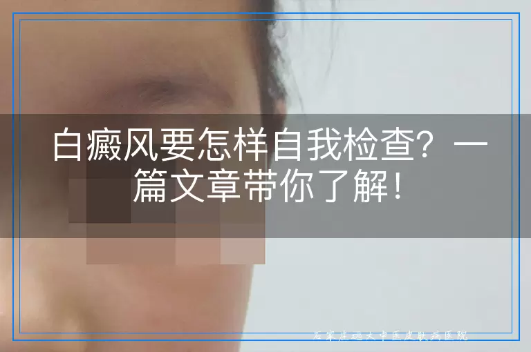 白癜风要怎样自我检查？一篇文章带你了解！