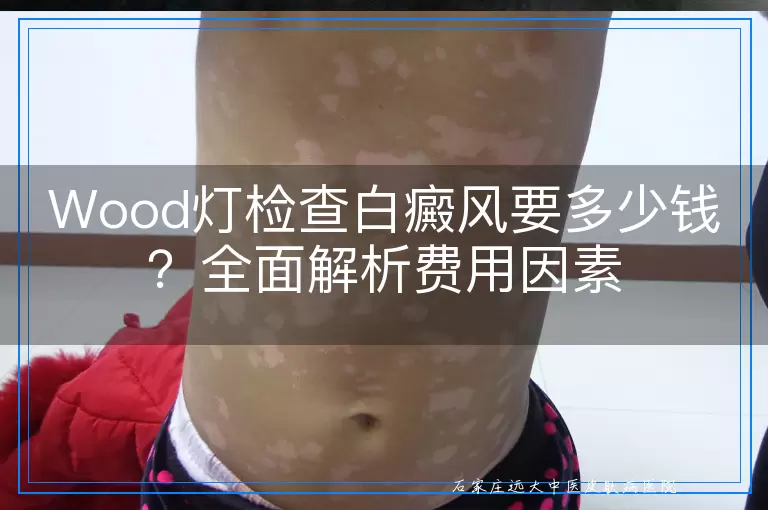 Wood灯检查白癜风要多少钱？全面解析费用因素