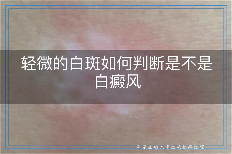 轻微的白斑如何判断是不是白癜风