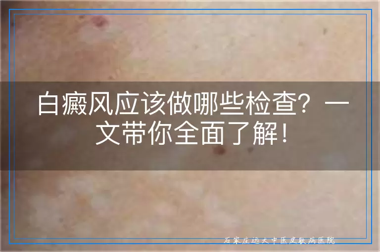 白癜风应该做哪些检查？一文带你全面了解！