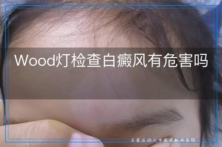 Wood灯检查白癜风有危害吗