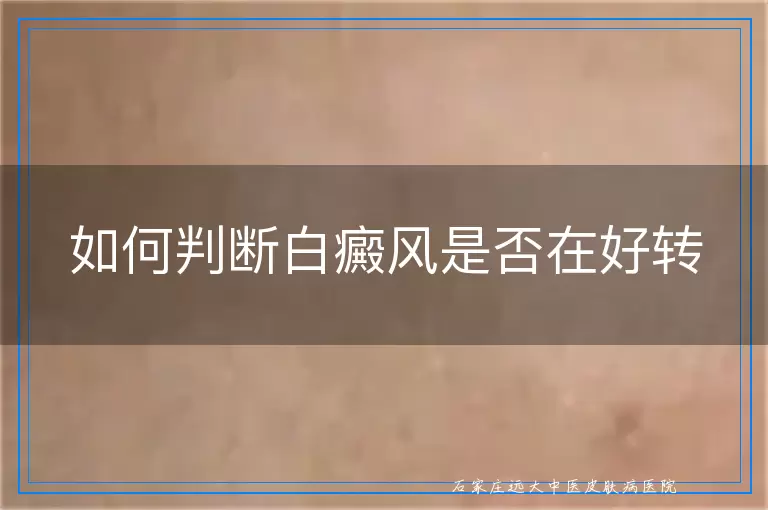 如何判断白癜风是否在好转