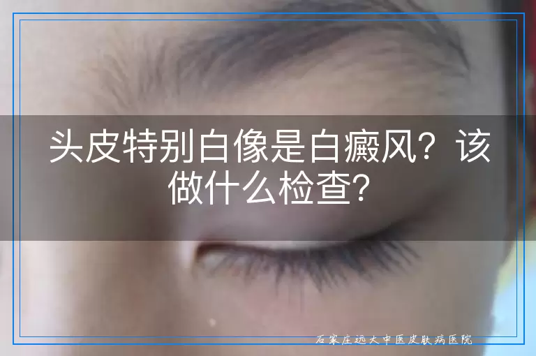 头皮特别白像是白癜风？该做什么检查？