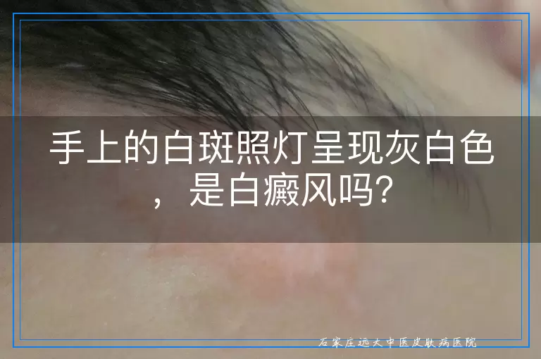 手上的白斑照灯呈现灰白色，是白癜风吗？